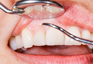 成人の約8割が歯周病といわれています